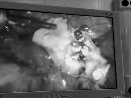 Уникальный случай: челюсть с зубами выросла у 27-летней девушки в кисте яичника