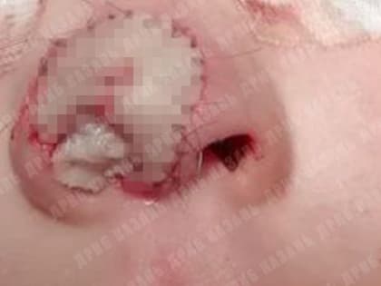 Врачи в Татарстане рассказали, как зашивают откушенные собаками детские носы