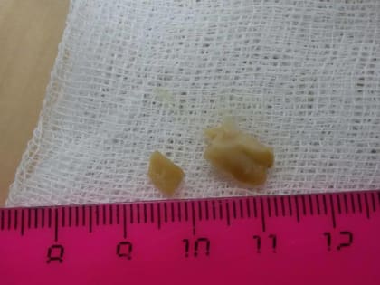 В ДРКБ прозентовали подборку предметов, которые были обнаружены в организмах детей