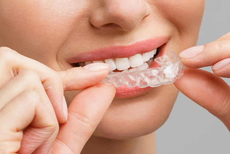 Kit Correcteur D'alignement Dentaire - Gouttières Orthodontie Temporaire, Générique - Neuf Sous Emballage