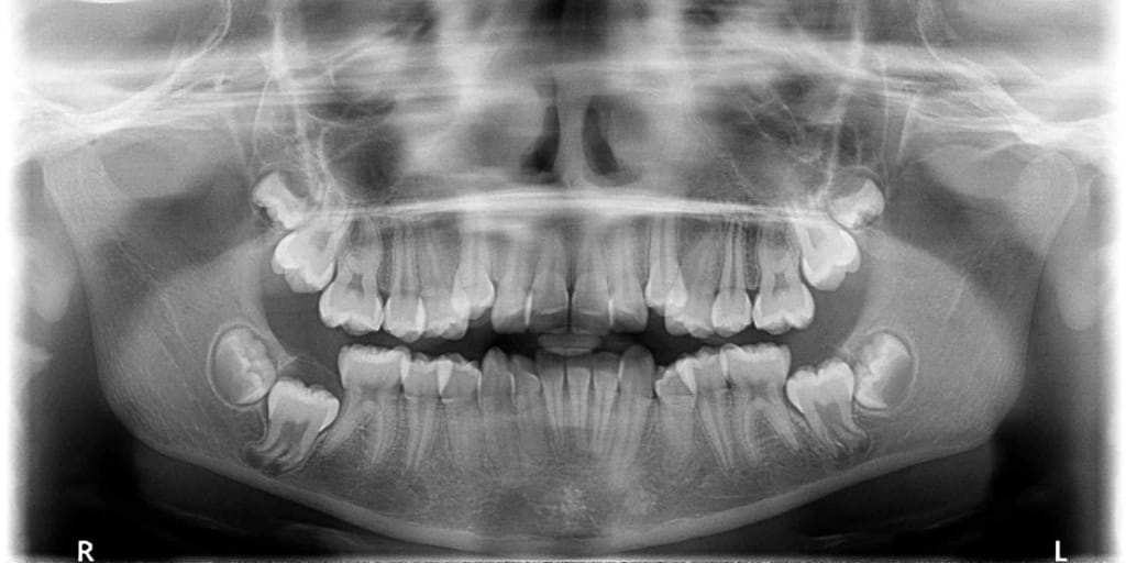 Exemple de radio panoramique réalisée lors d'un bilan orthodontique