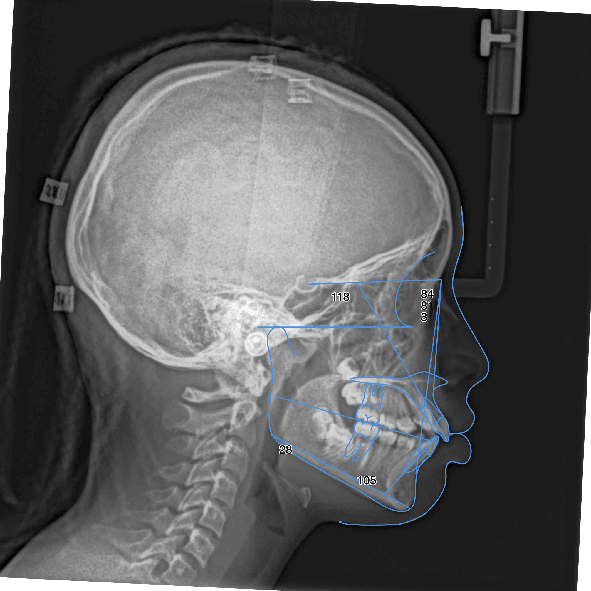 Le bilan orthodontique