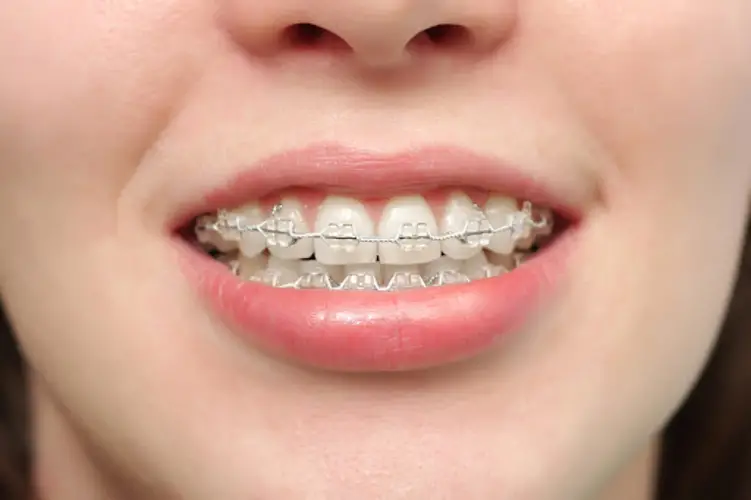 40 tuổi có niềng răng được không? Cách chăm sóc răng miệng sau niềng răng