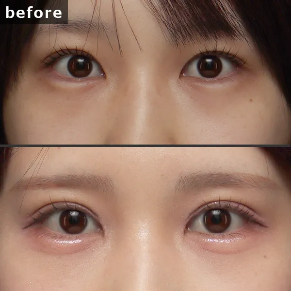 二重埋没+目頭上切開治療前後の写真