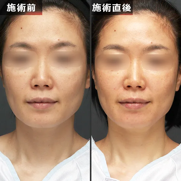 ソフウェーブ施術による正面からのたるみ・フェイスラインの引き締め効果(Before/After)