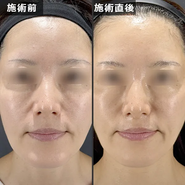 ソフウェーブ施術による正面からのたるみ・フェイスラインの引き締め効果(Before/After)