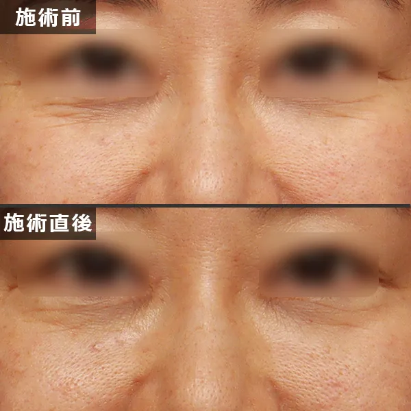 ソフウェーブ施術による正面からのたるみ・フェイスラインの引き締め効果(Before/After)