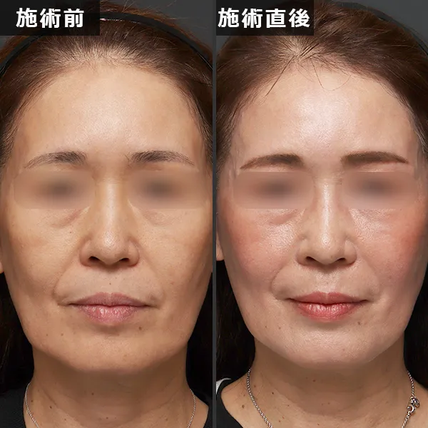 銀座Maison Purejuのサーマジェン施術による、たるみとほうれい線が改善されたビフォーアフター症例写真