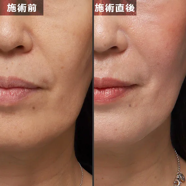 銀座Maison Purejuのサーマジェン施術による、たるみとほうれい線が改善されたビフォーアフター症例写真