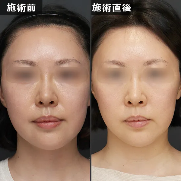 銀座Maison Purejuのサーマジェン施術による、たるみとほうれい線が改善されたビフォーアフター症例写真