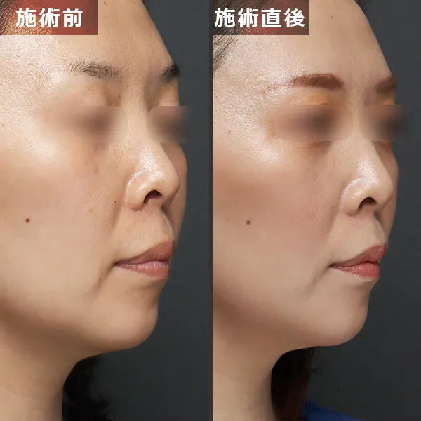 銀座Maison Purejuのサーマジェン施術による、たるみとほうれい線が改善されたビフォーアフター症例写真