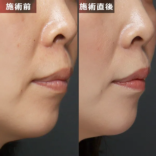 銀座Maison Purejuのサーマジェン施術による、たるみとほうれい線が改善されたビフォーアフター症例写真
