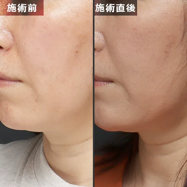 銀座Maison Purejuのサーマジェン施術による、たるみとほうれい線が改善されたビフォーアフター症例写真