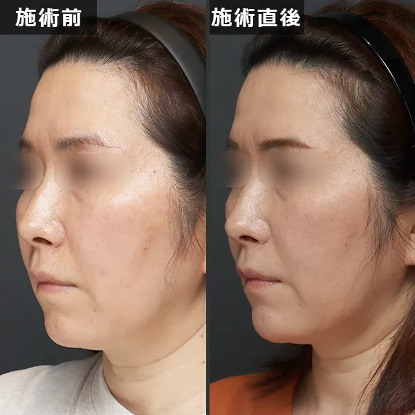 銀座Maison Purejuのサーマジェン施術による、たるみとほうれい線が改善されたビフォーアフター症例写真