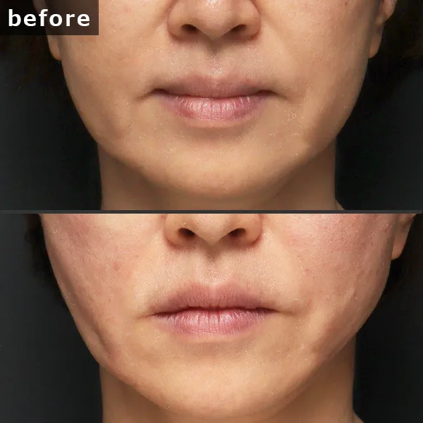 【銀座 糸リフト症例】 [悩み]が施術後に劇的に改善し、[具体的な結果]が実現したビフォーアフター写真。Maison Pureju。