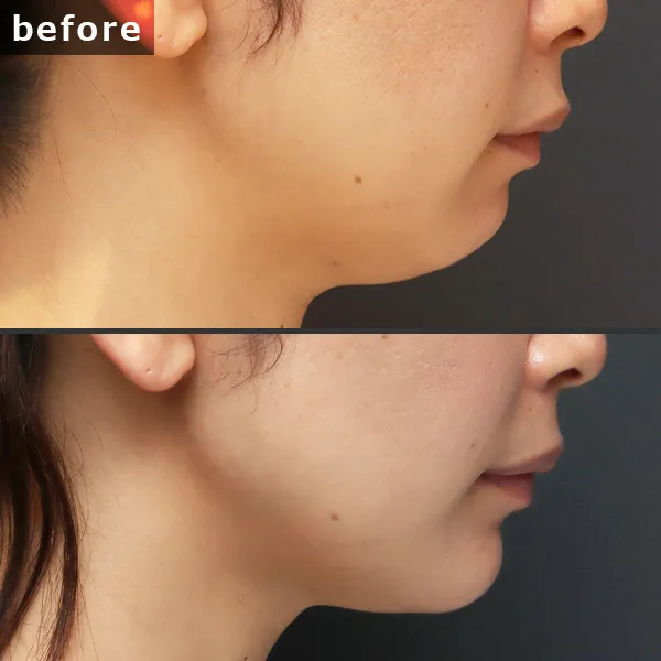 【銀座 糸リフト症例】 [悩み]が施術後に劇的に改善し、[具体的な結果]が実現したビフォーアフター写真。Maison Pureju。