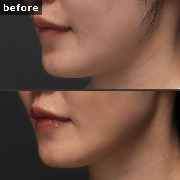 【銀座 糸リフト症例】 [悩み]が施術後に劇的に改善し、[具体的な結果]が実現したビフォーアフター写真。Maison Pureju。