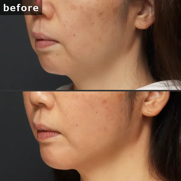 【銀座 糸リフト症例】 [悩み]が施術後に劇的に改善し、[具体的な結果]が実現したビフォーアフター写真。Maison Pureju。