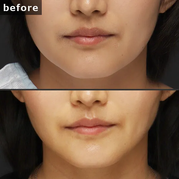 【銀座 糸リフト症例】 [悩み]が施術後に劇的に改善し、[具体的な結果]が実現したビフォーアフター写真。Maison Pureju。