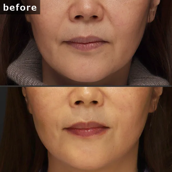 【銀座 糸リフト症例】 [悩み]が施術後に劇的に改善し、[具体的な結果]が実現したビフォーアフター写真。Maison Pureju。