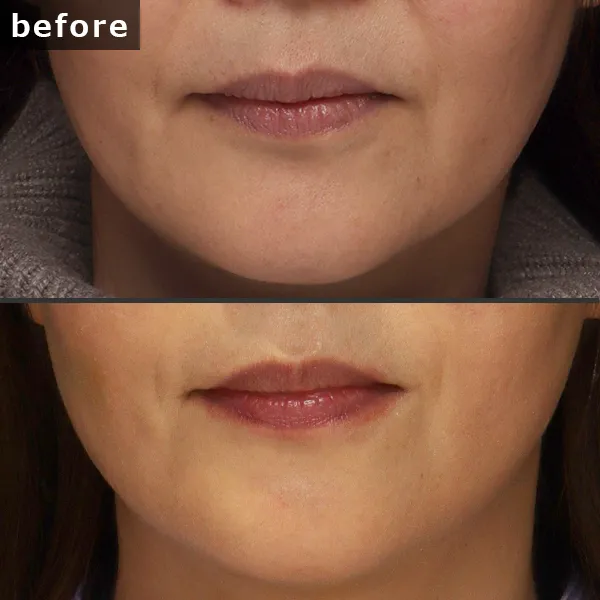 【銀座 糸リフト症例】 [悩み]が施術後に劇的に改善し、[具体的な結果]が実現したビフォーアフター写真。Maison Pureju。