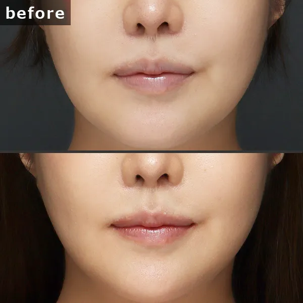 【銀座 糸リフト症例】 [悩み]が施術後に劇的に改善し、[具体的な結果]が実現したビフォーアフター写真。Maison Pureju。