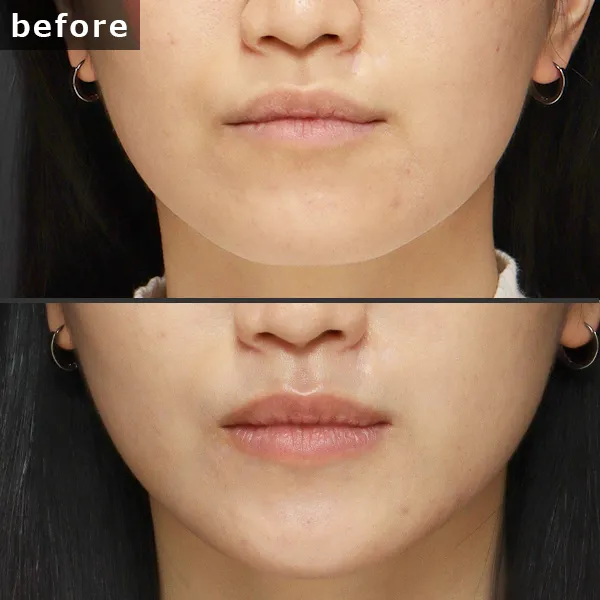 【銀座 糸リフト症例】 [悩み]が施術後に劇的に改善し、[具体的な結果]が実現したビフォーアフター写真。Maison Pureju。