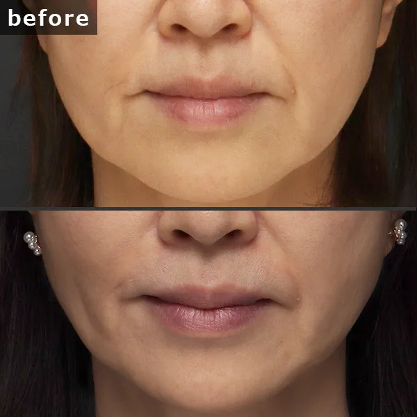 【銀座 糸リフト症例】 [悩み]が施術後に劇的に改善し、[具体的な結果]が実現したビフォーアフター写真。Maison Pureju。