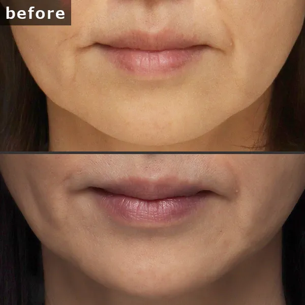 【銀座 糸リフト症例】 [悩み]が施術後に劇的に改善し、[具体的な結果]が実現したビフォーアフター写真。Maison Pureju。