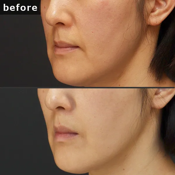 【銀座 糸リフト症例】 [悩み]が施術後に劇的に改善し、[具体的な結果]が実現したビフォーアフター写真。Maison Pureju。