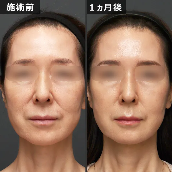 ソフウェーブ症例｜全顔のたるみを改善しフェイスラインが整った実例｜銀座Maison Pureju