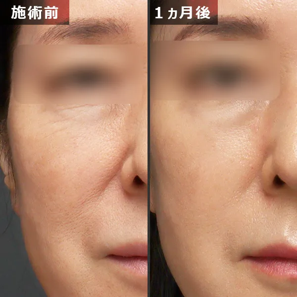 ソフウェーブ症例｜全顔のたるみを改善しフェイスラインが整った実例｜銀座Maison Pureju