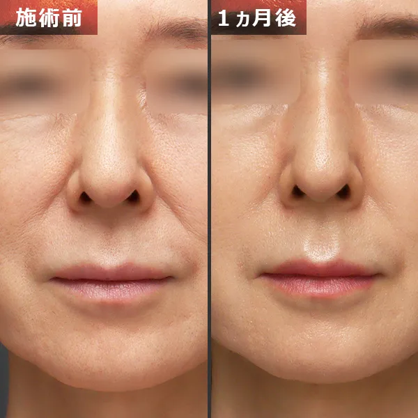 ソフウェーブ症例｜全顔のたるみを改善しフェイスラインが整った実例｜銀座Maison Pureju