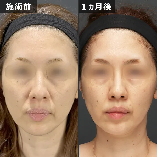ソフウェーブ症例｜全顔のたるみを改善しフェイスラインが整った実例｜銀座Maison Pureju