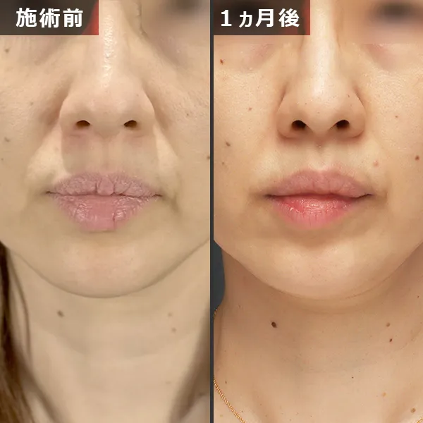 ソフウェーブ症例｜全顔のたるみを改善しフェイスラインが整った実例｜銀座Maison Pureju