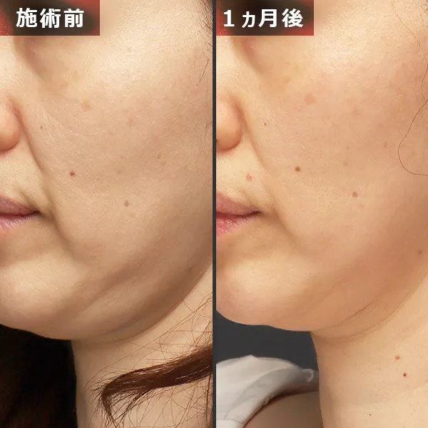 ソフウェーブ症例｜全顔のたるみを改善しフェイスラインが整った実例｜銀座Maison Pureju