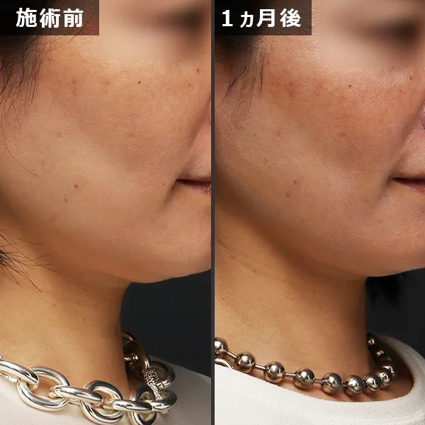 ソフウェーブ症例｜全顔のたるみを改善しフェイスラインが整った実例｜銀座Maison Pureju