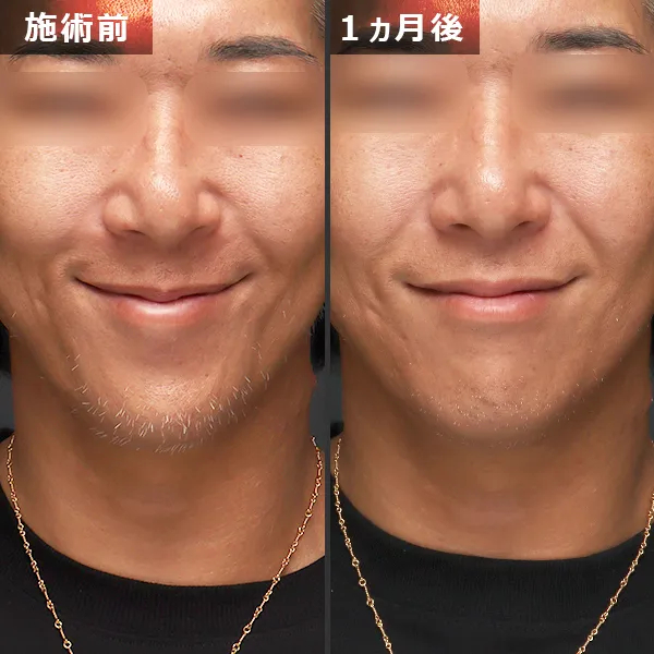 ソフウェーブ症例｜全顔のたるみを改善しフェイスラインが整った実例｜銀座Maison Pureju