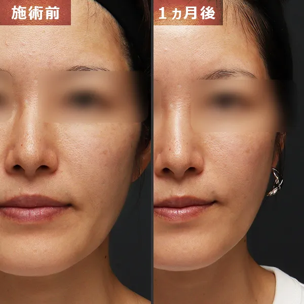 ソフウェーブ症例｜全顔のたるみを改善しフェイスラインが整った実例｜銀座Maison Pureju