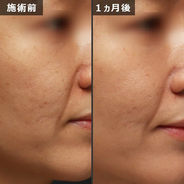 ソフウェーブ症例｜全顔のたるみを改善しフェイスラインが整った実例｜銀座Maison Pureju