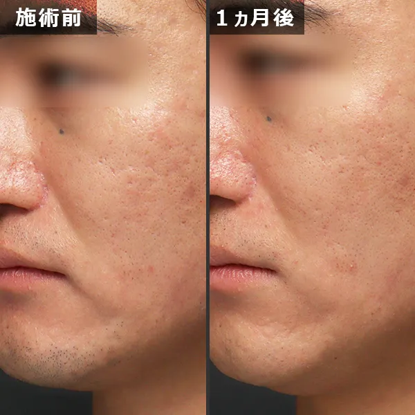 ソフウェーブ症例｜全顔のたるみを改善しフェイスラインが整った実例｜銀座Maison Pureju