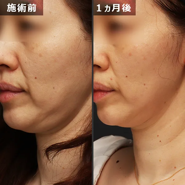 ソフウェーブ症例｜全顔のたるみを改善しフェイスラインが整った実例｜銀座Maison Pureju