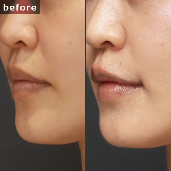 【40代女性・口角挙上1ヶ月後】銀座 Maison PUREJU の症例。加齢で下がり始めた口角を切開法でリフトアップ。術後の赤みが落ち着き、口元のたるみ感が改善され始めた状態。