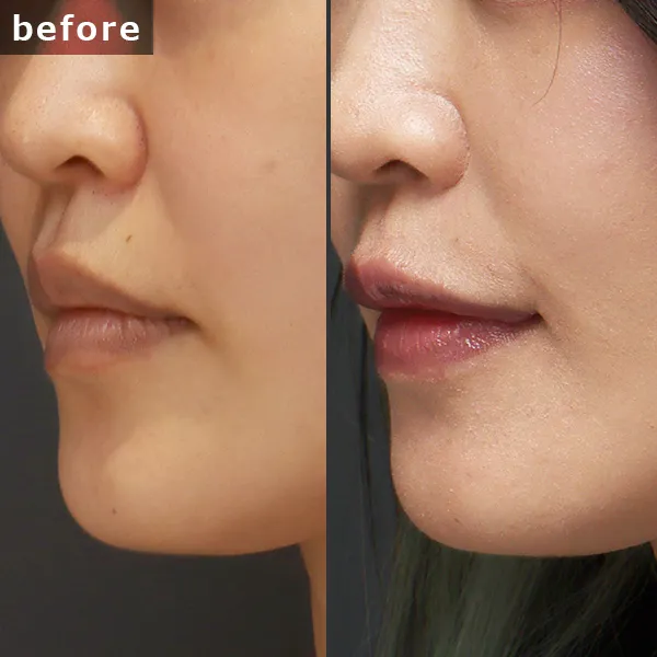 【40代女性・術後6ヶ月】口角挙上とヒアルロン酸注入の併用症例。銀座 Maison PUREJU によるトータルデザイン。口角の高さと唇のボリュームを同時に叶え、若々しく上品な口元へ。