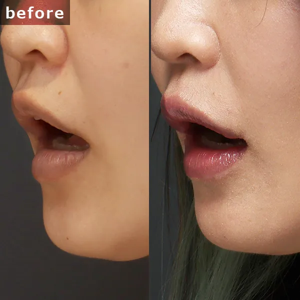 【40代女性・術後6ヶ月】口角挙上とヒアルロン酸注入の併用症例。銀座 Maison PUREJU によるトータルデザイン。口角の高さと唇のボリュームを同時に叶え、若々しく上品な口元へ。