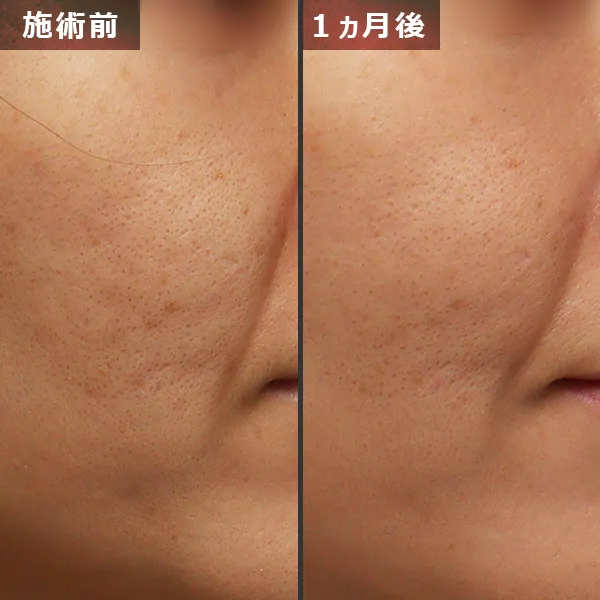 ソフウェーブ症例｜全顔のたるみを改善しフェイスラインが整った実例｜銀座Maison Pureju