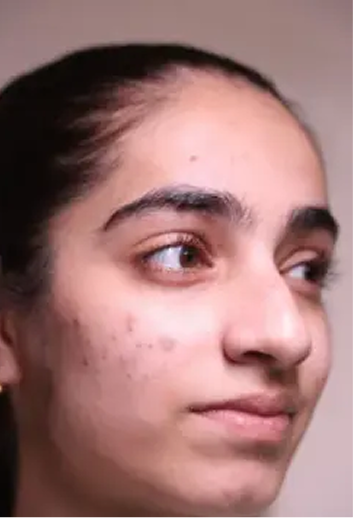 Acne Arrestor Facial With Salicylic Peel