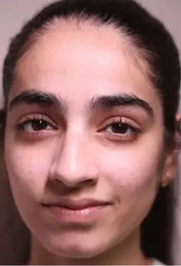 Acne Arrestor Facial With Salicylic Peel