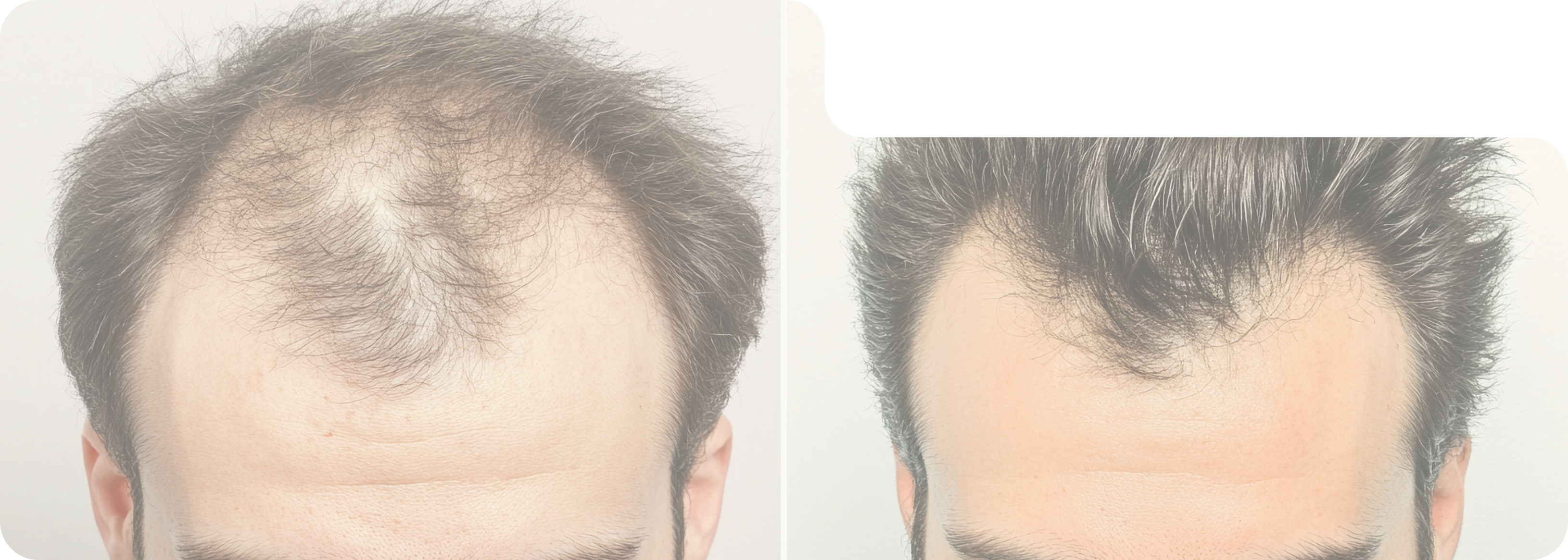Scalp Preparation