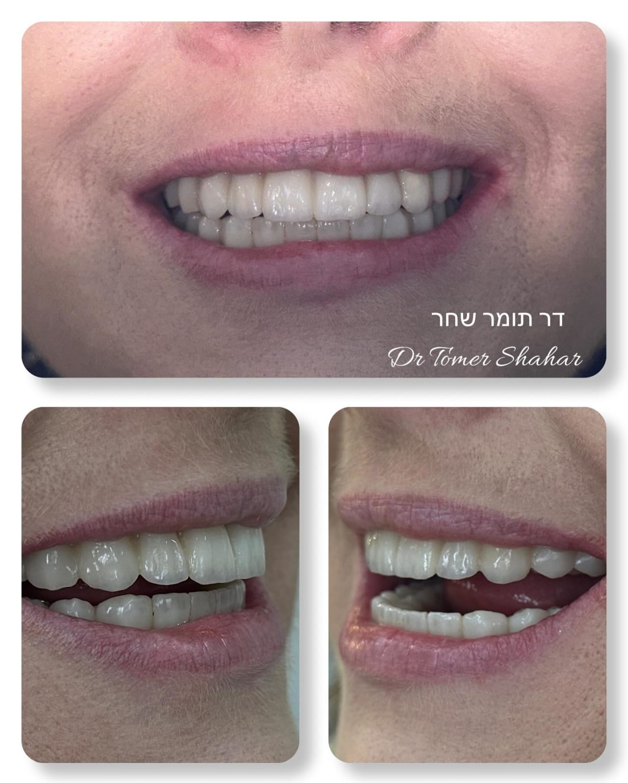 ציפויי חרסינה